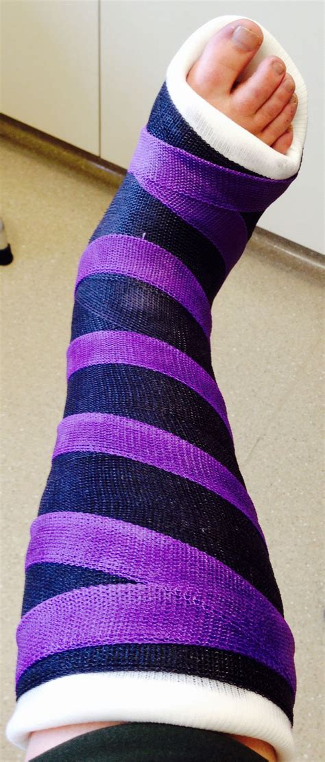 My spiffy new cast which my daughter has dubbed the "Cheshire Cast ...