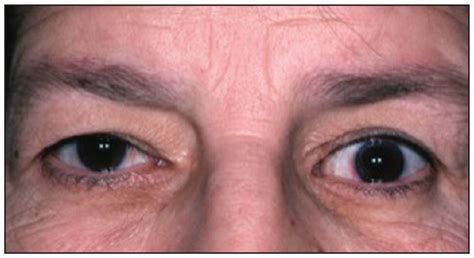 Thyroid eye disease | CMAJ