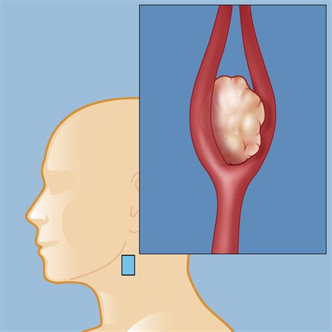 Carotid Body Tumors | Weill Cornell Brain and Spine Center