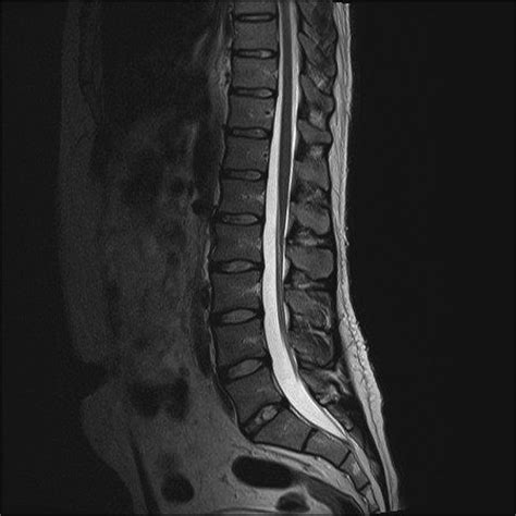 Lumbar Spine Mri Labeled