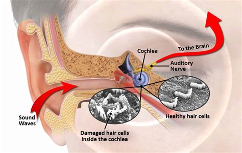 What is noise-induced hearing loss (NIHL)? | Bend, OR & Redmond, OR