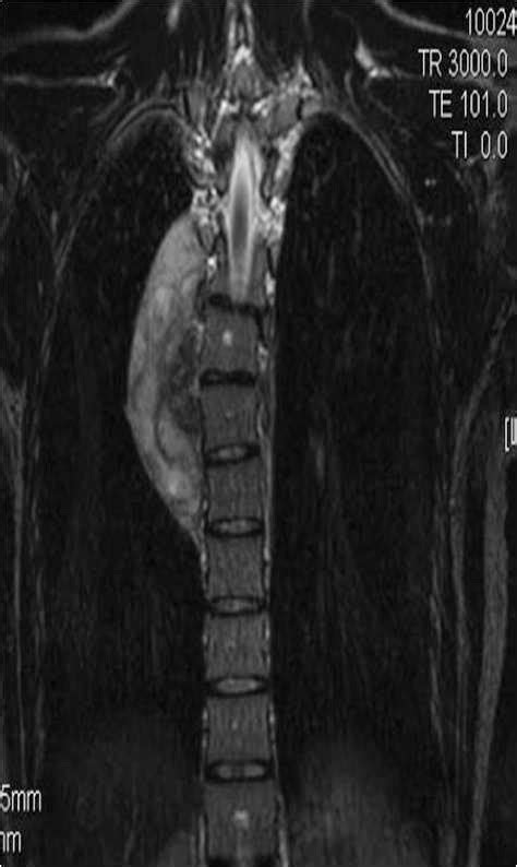 RADIOLOGY IMAGE SPOTTERS: Ganglioneuroma