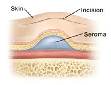 How To Get Rid Of Seroma - Soupcrazy1