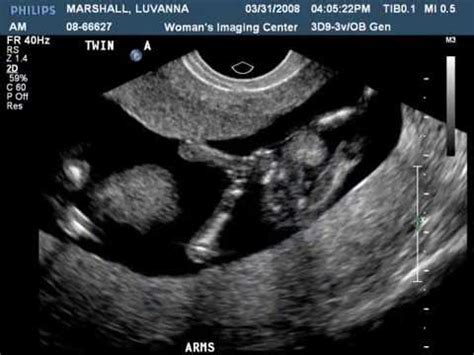 Identical Twins Ultrasound - YouTube