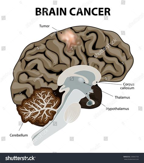 Ein Hirntumor ist ein abnormales Wachstum: Stock-Vektorgrafik ...