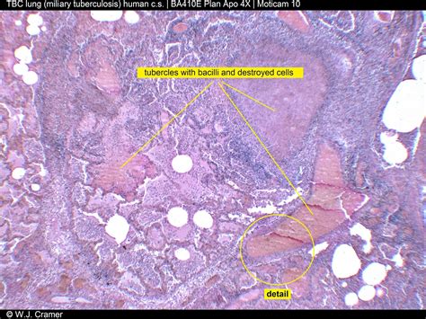 Miliary Tuberculosis Histology