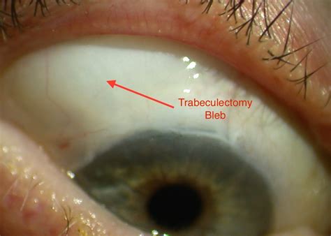 Trabeculectomy Bleb-min - Applecross Eye Clinic