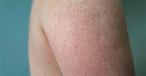 Keratosis Pilaris Treatment: From Creams to Lasers