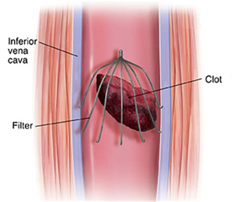 Understanding Inferior Vena Cava (IVC) Filter Placement | Saint Luke's Health System