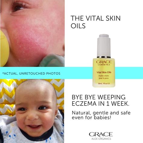 Baby Weeping Eczema | Oils for skin, Natural eczema remedies, Eczema