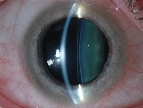 Implantable Collamer Lens (ICL) Surgery | Wills Eye Hospital