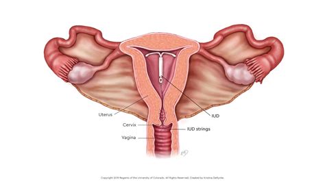 IUD Insertion with Anesthesia | Children's Hospital Colorado