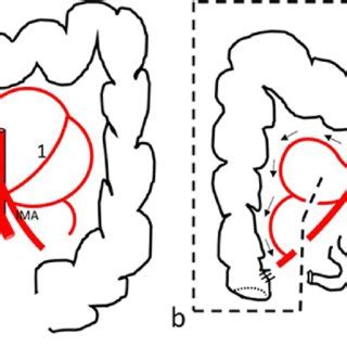 Diagram demonstrating rare variation in the anatomy of middle colic... | Download Scientific Diagram