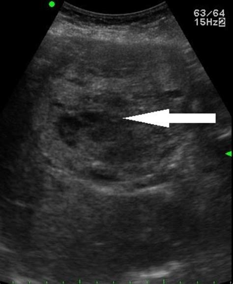 Liver Cancer Ultrasound