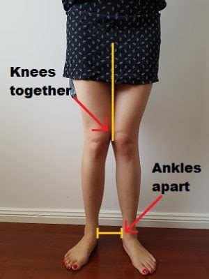 How To Fix Knee Valgus - Posture Direct