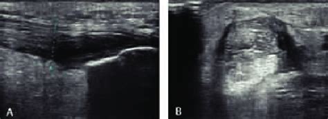 Ultrasound of the Achilles tendon (case n. 8). (A) Longitudinal view of... | Download Scientific ...