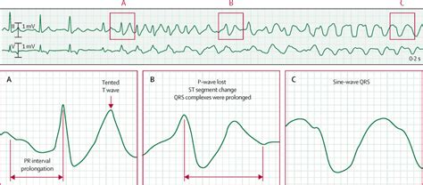 Rapidly changing ECG in hyperkalaemia after succinylcholine - The Lancet