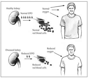 Renal failure anemia - SYMPTOMS AND DIAGNOSIS