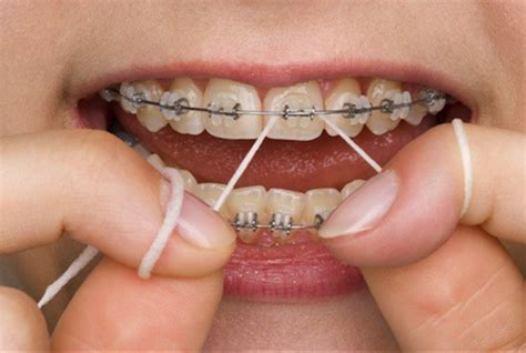 How to floss with braces on? | News | Dentagama