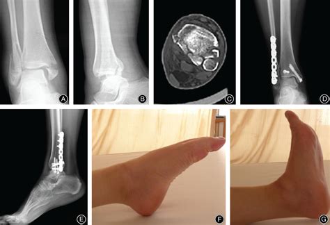 Treatment of Medial Malleolus or Pure Deltoid Ligament Injury in ...