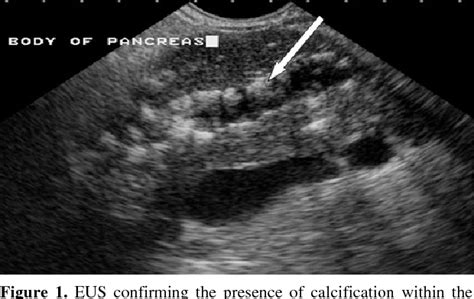 Figure 1 from Endoscopic ultrasound reliably identifies chronic pancreatitis when other imaging ...