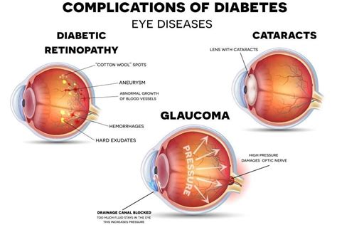 Diabetic Eye Disease | Invision Optometry