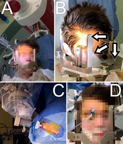 Corpus callosotomy performed with laser interstitial thermal therapy ...