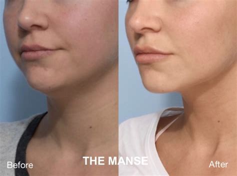 Double Chin Injections in Sydney | The Manse Clinic