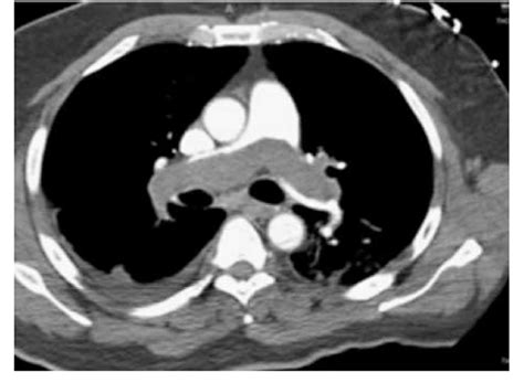 Saddle Pulmonary Embolism Xray