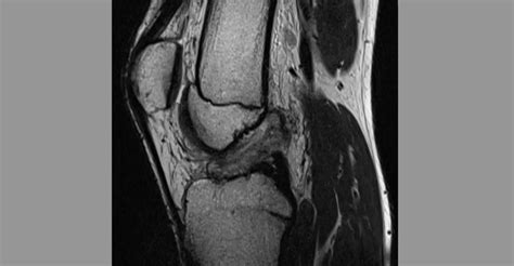 How Do We Treat An ACL Tear? - Pro doctor