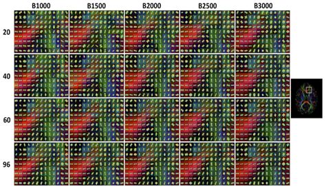 Effects of b-Value and Number of Gradient Directions on Diffusion MRI ...