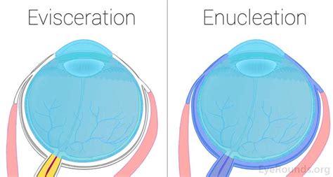 Enucleation and Evisceration: What to Expect