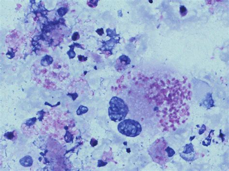 Microphotograph showing foamy macrophages having intracellular... | Download Scientific Diagram