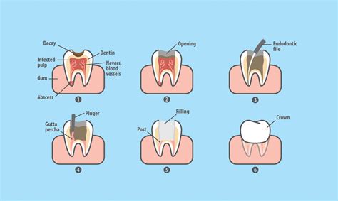 What is Endodontics? - Loock Dental