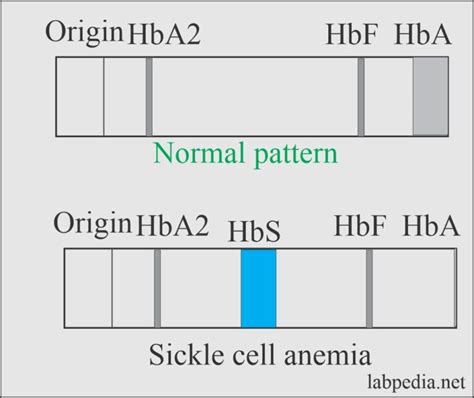 Anemia:- Part 5 A - Sickle Cell Anemia, and Sickle Cell Trait ...