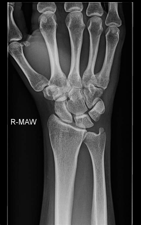 OrthoDx: Isolated Ulnar Styloid Fracture - Clinical Advisor