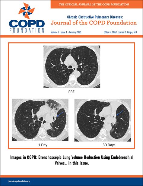 Cough and Phlegm in People with COPD | Journal of The COPD Foundation