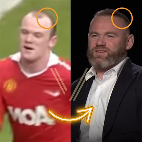 Wayne Rooney Hair Transplant 2024 - Hildy Latisha