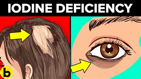 7 Signs You Have An Iodine Deficiency - YouTube