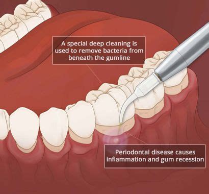 Gum Disease Treatment in Brooklyn NY - LuxDen Dental Center