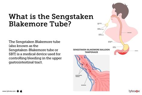 Sengstaken Blakemore Tube: Causes, Symptoms, Treatment and Cost