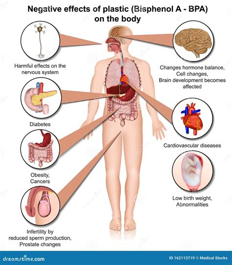 Bisphenol S Effects On The Human Body 3d Medical Vector Illustration ...