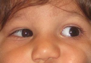 Duane Syndrome - Pediatric Ophthalmic Consultants