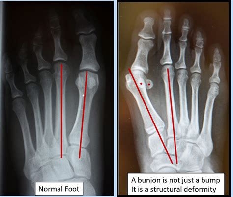 Bunions with Metatarsus Adductus - Bunion Surgery Specialists