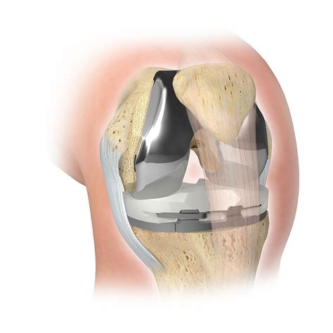 Zimmer Biomet - Knee Replacement