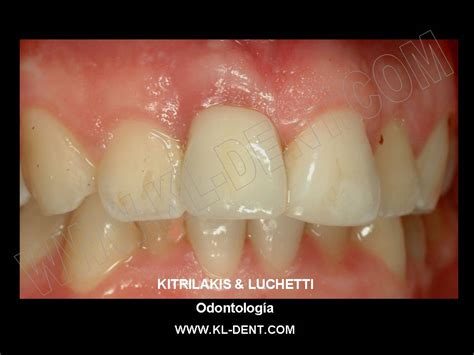 Kitrilakis & Luchetti - Dentistry: Dental Implant in Upper Central Incisor: Case 1