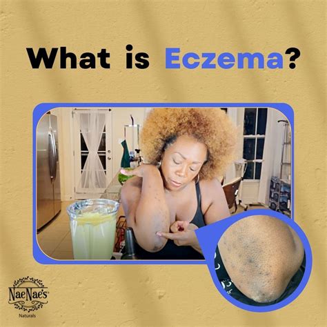 Eczema is an itchy inflammation of the skin😪 It causes itchiness, dry ...