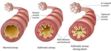 Approach to Asthma in the ED - CanadiEM