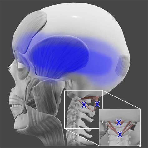 Acupuncture for Suboccipital Muscles — Morningside Acupuncture NYC