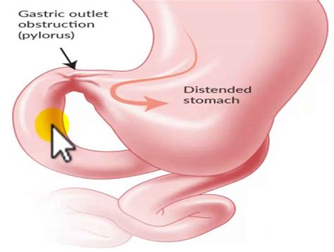 Important Discussion About Gastric Outlet Obstruction – Platform | CME